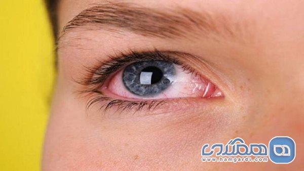 عوارض چشمی کرونا از خود کرونا بدتر هستند