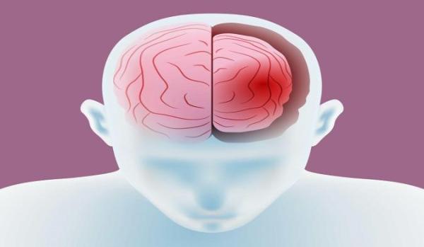 هرآنچه که باید راجع به آتروفی مغزی بدانیم